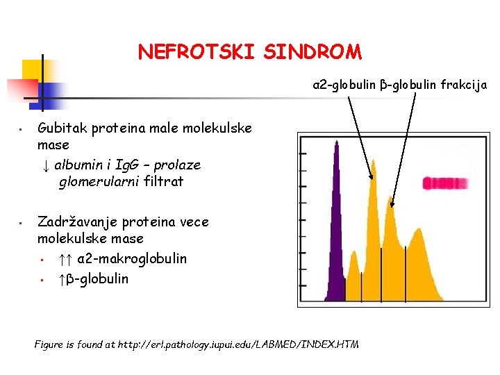 NEFROTSKI SINDROM α 2 -globulin β-globulin frakcija • • Gubitak proteina male molekulske mase