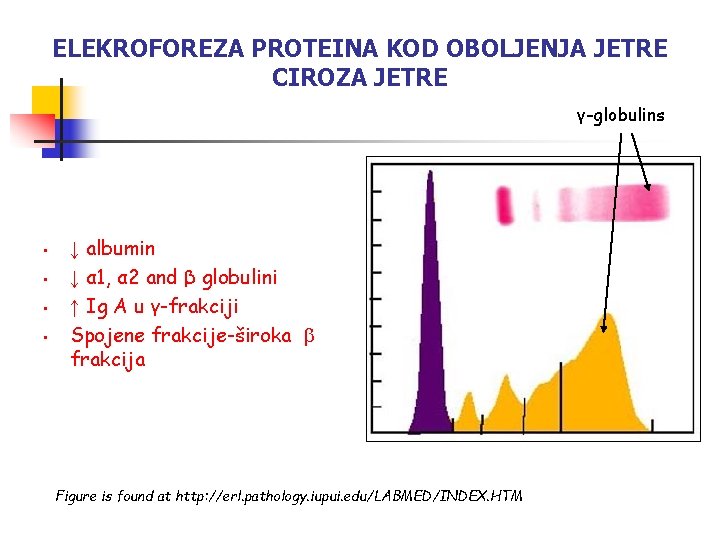 ELEKROFOREZA PROTEINA KOD OBOLJENJA JETRE CIROZA JETRE γ-globulins • • ↓ albumin ↓ α