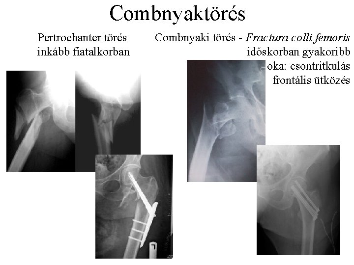 Combnyaktörés Pertrochanter törés inkább fiatalkorban Combnyaki törés - Fractura colli femoris időskorban gyakoribb oka: