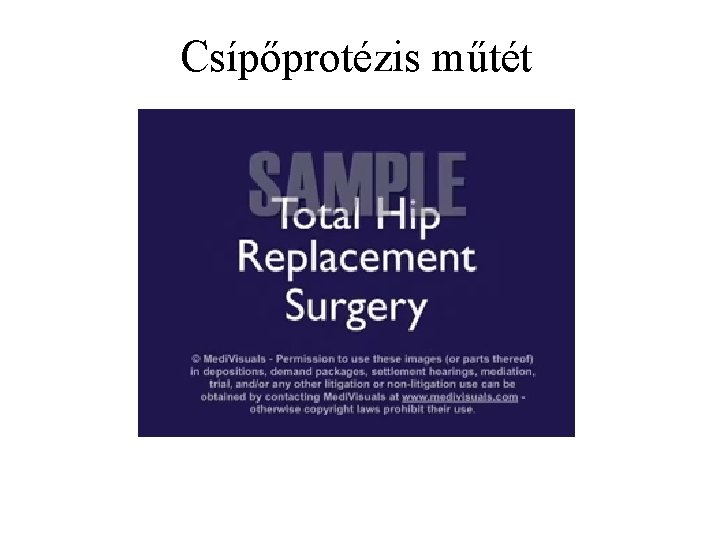 Csípőprotézis műtét 