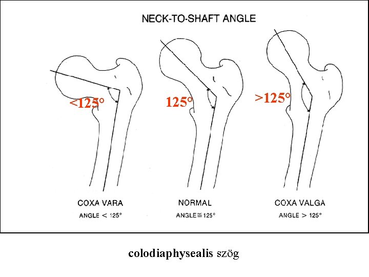 <125° colodiaphysealis szög >125° 