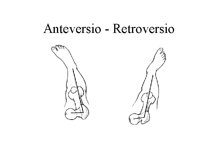 Anteversio - Retroversio 
