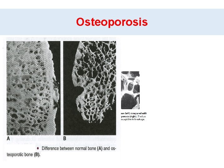 Osteoporosis Osteoporosis