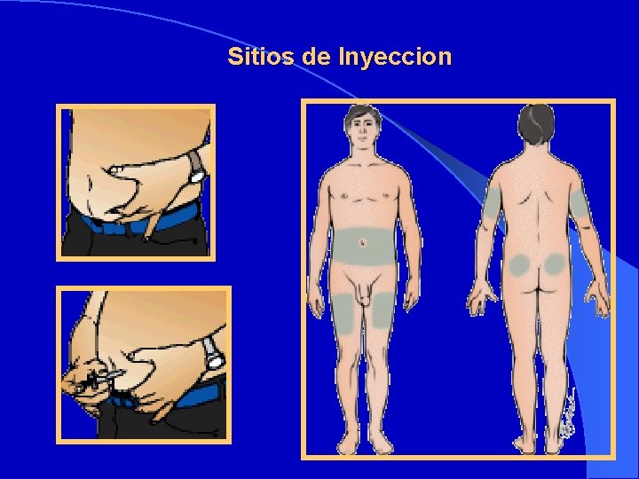 Sitios de Inyeccion 