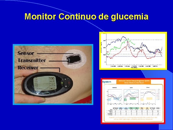 Monitor Continuo de glucemia 