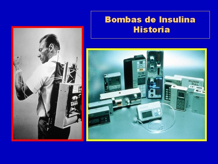 Bombas de Insulina Historia 