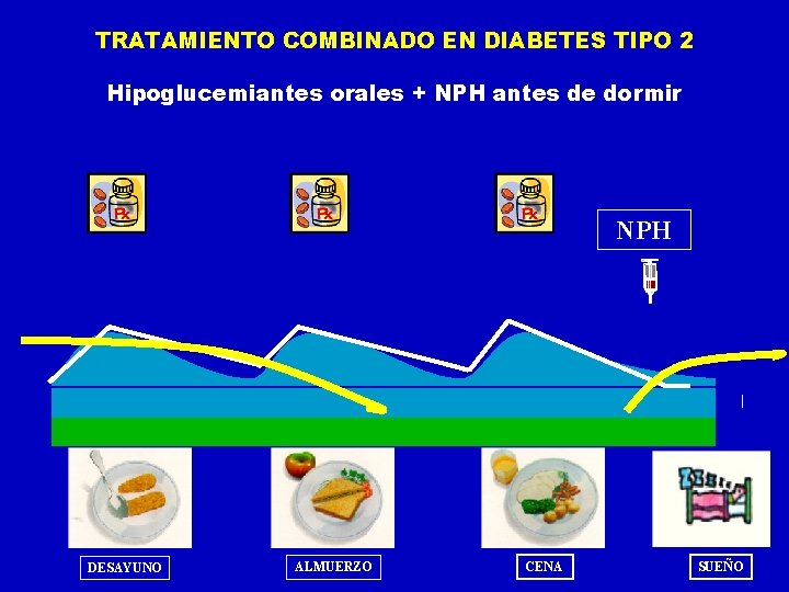 TRATAMIENTO COMBINADO EN DIABETES TIPO 2 Hipoglucemiantes orales + NPH antes de dormir NPH