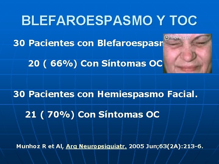 BLEFAROESPASMO Y TOC 30 Pacientes con Blefaroespasmo. 20 ( 66%) Con Síntomas OC 30