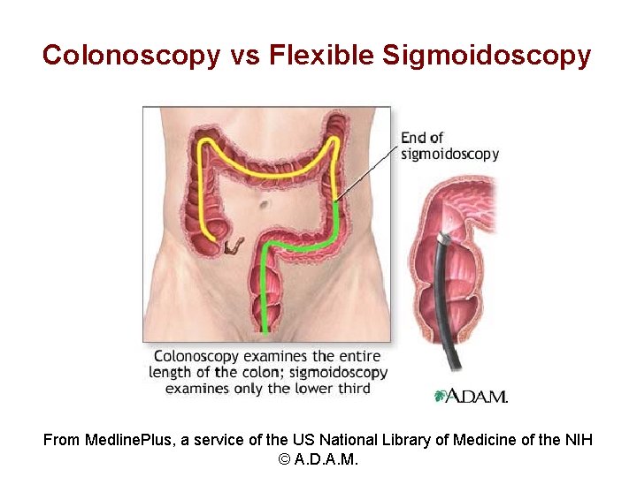 Colonoscopy vs Flexible Sigmoidoscopy From Medline. Plus, a service of the US National Library