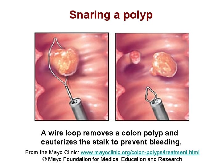 Snaring a polyp A wire loop removes a colon polyp and cauterizes the stalk