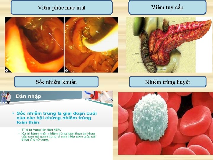 Viêm phúc mạc mật Sốc nhiễm khuẩn Viêm tụy cấp Nhiễm trùng huyết 