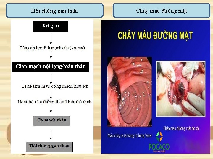 Hội chứng gan thận Chảy máu đường mật 