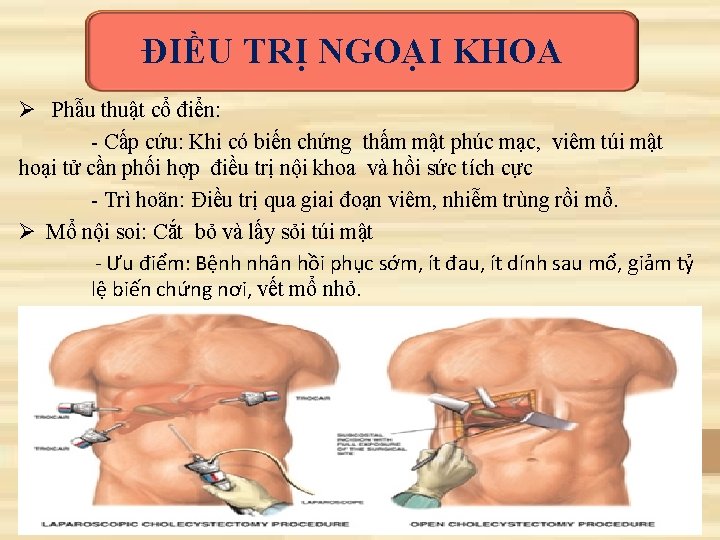 ĐIỀU TRỊ NGOẠI KHOA Ø Phẫu thuật cổ điển: - Cấp cứu: Khi có