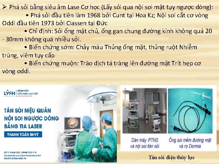 Ø Phá sỏi bằng siêu âm Lase Cơ học (Lấy sỏi qua nội soi