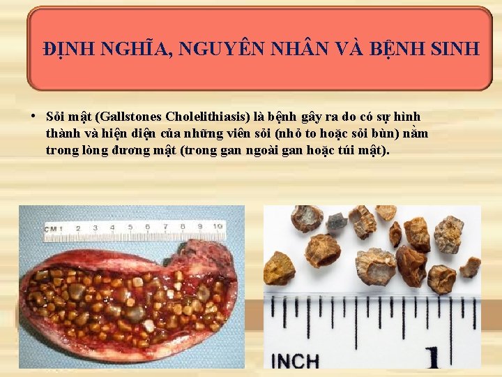 ĐỊNH NGHĨA, NGUYÊN NH N VÀ BỆNH SINH • Sỏi mật (Gallstones Cholelithiasis) là