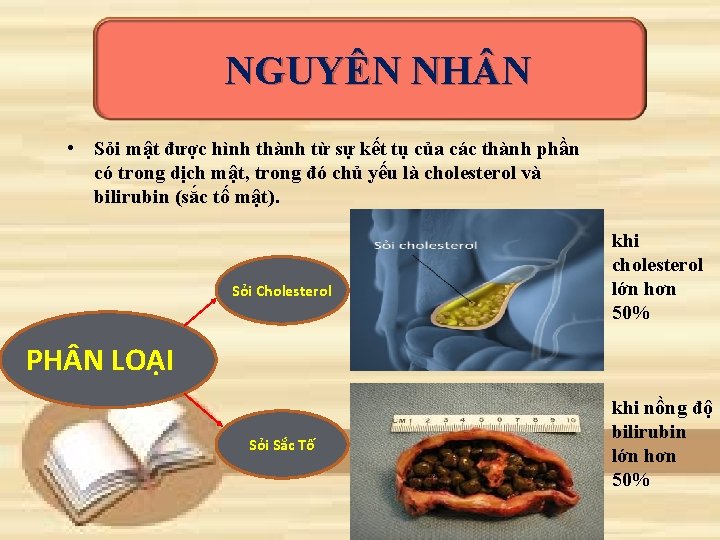 NGUYÊN NH N • Sỏi mật được hình thành từ sự kết tụ của