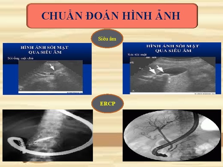 CHUẨN ĐOÁN HÌNH ẢNH Siêu âm ERCP 