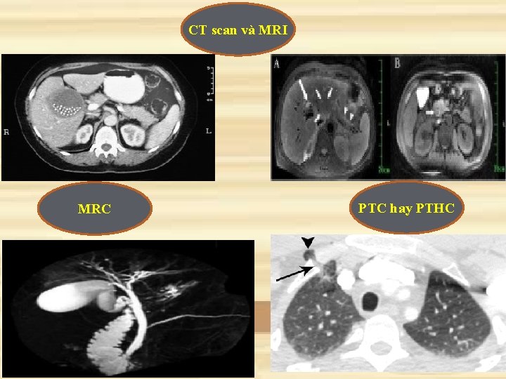 CT scan và MRI MRC PTC hay PTHC 