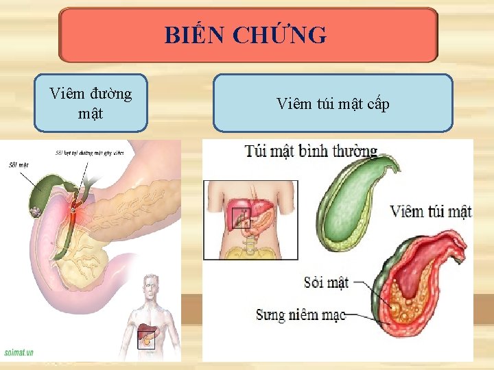 BIẾN CHỨNG Viêm đường mật Viêm túi mật cấp 