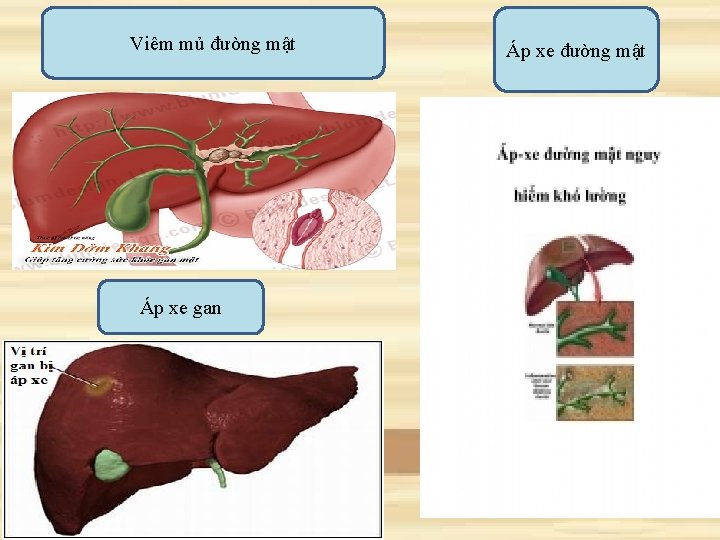 Viêm mủ đường mật Áp xe gan Áp xe đường mật 