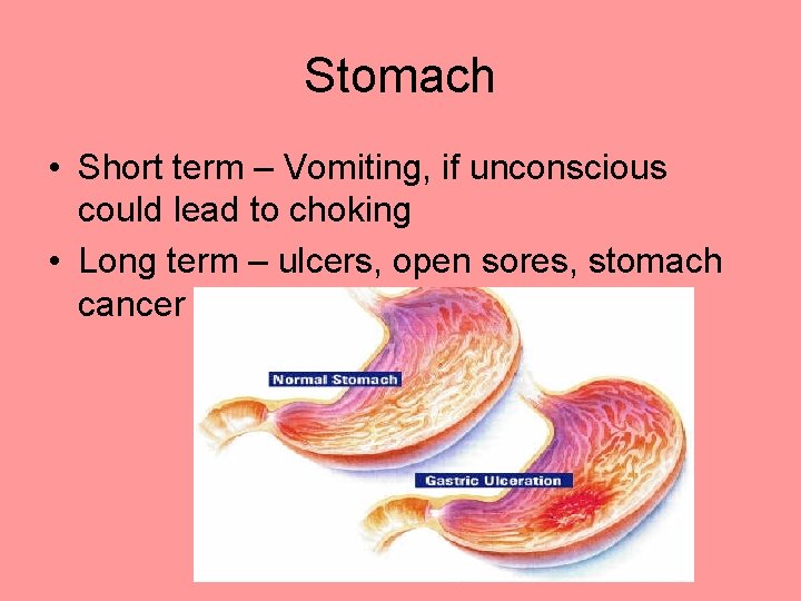 Stomach • Short term – Vomiting, if unconscious could lead to choking • Long