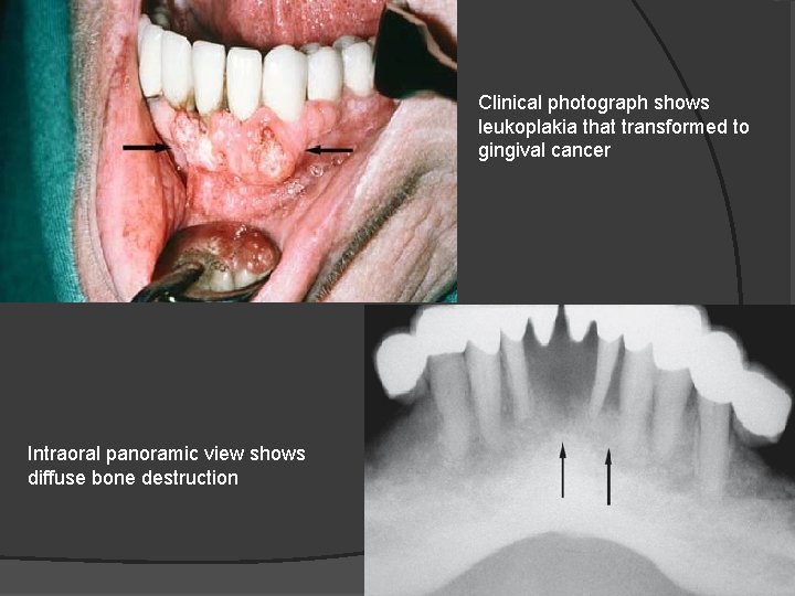 Clinical photograph shows leukoplakia that transformed to gingival cancer Intraoral panoramic view shows diffuse