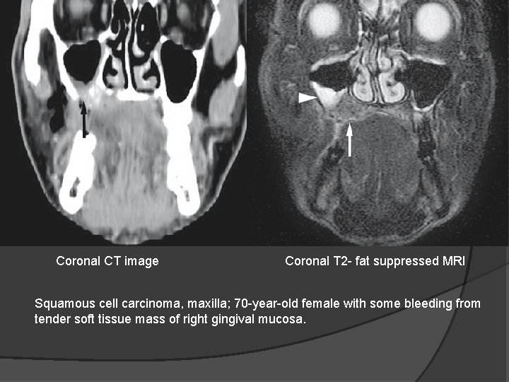 Coronal CT image Coronal T 2 - fat suppressed MRI Squamous cell carcinoma, maxilla;