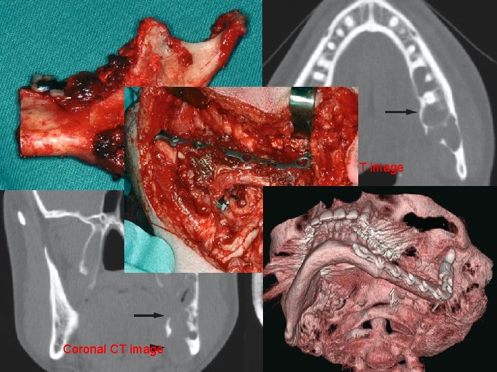 Panoramic view Coronal CT image Axial CT image Coronal T 1 -weighted post-Gd MRI