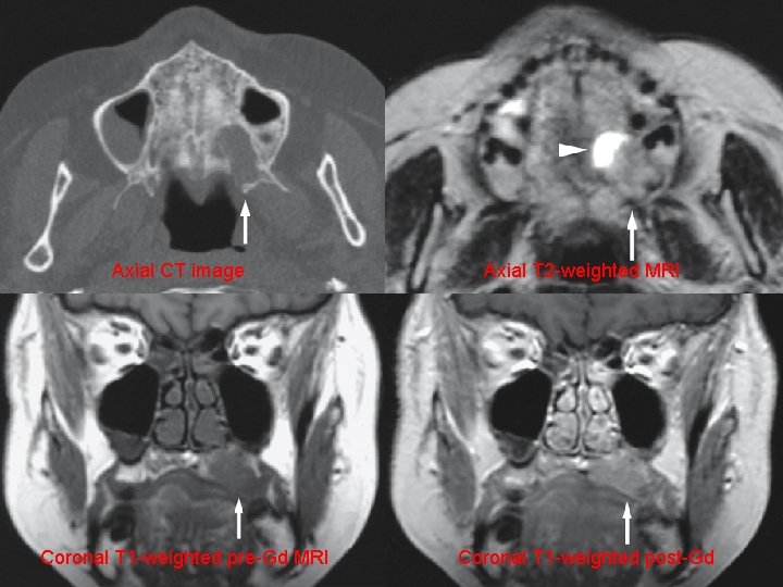 Axial CT image Coronal T 1 -weighted pre-Gd MRI Axial T 2 -weighted MRI