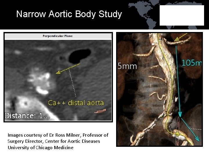 Narrow Aortic Body Study Images courtesy of Dr Ross Milner, Professor of Surgery Director,