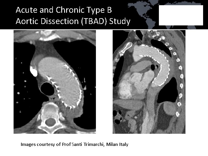 Acute and Chronic Type B Aortic Dissection (TBAD) Study Images courtesy of Prof Santi