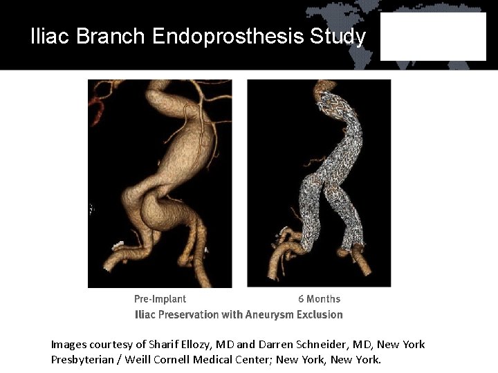 Iliac Branch Endoprosthesis Study Images courtesy of Sharif Ellozy, MD and Darren Schneider, MD,