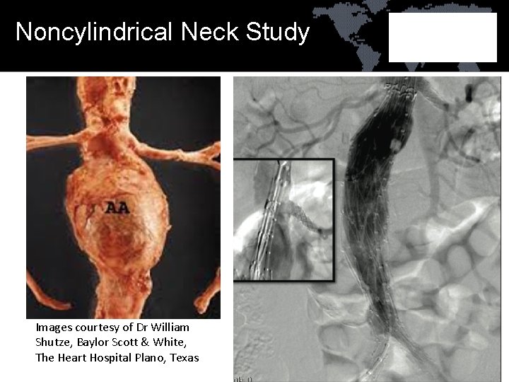 Noncylindrical Neck Study Images courtesy of Dr William Shutze, Baylor Scott & White, The