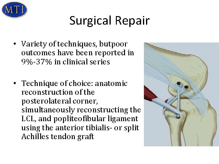 Surgical Repair • Variety of techniques, butpoor outcomes have been reported in 9%-37% in