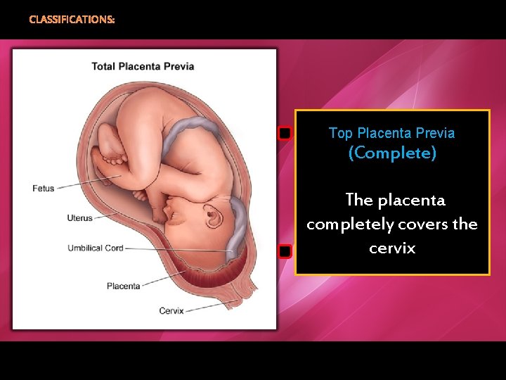 CLASSIFICATIONS: Top Placenta Previa (Complete) The placenta completely covers the cervix 