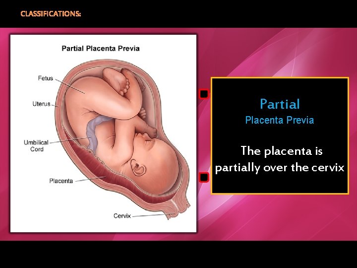 CLASSIFICATIONS: Partial Placenta Previa The placenta is partially over the cervix 
