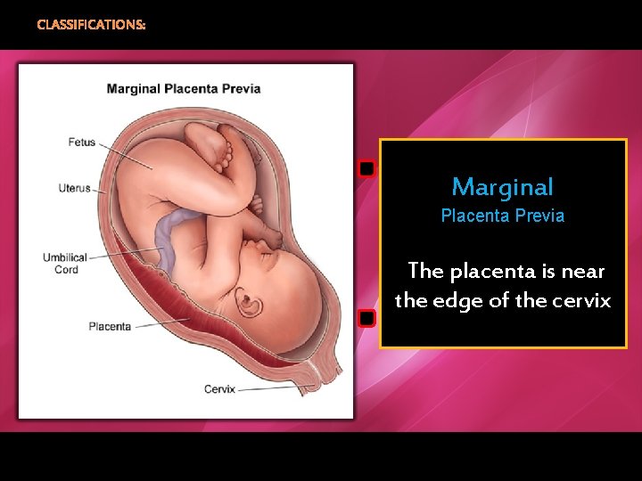 CLASSIFICATIONS: Marginal Placenta Previa The placenta is near the edge of the cervix 