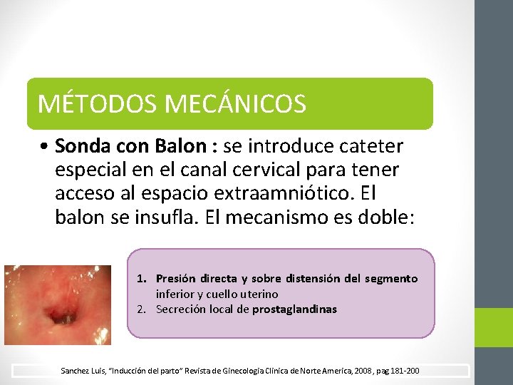 MÉTODOS MECÁNICOS • Sonda con Balon : se introduce cateter especial en el canal