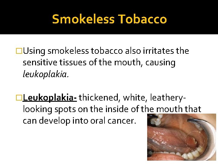 Smokeless Tobacco �Using smokeless tobacco also irritates the sensitive tissues of the mouth, causing