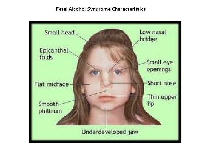Fetal Alcohol Syndrome Characteristics 