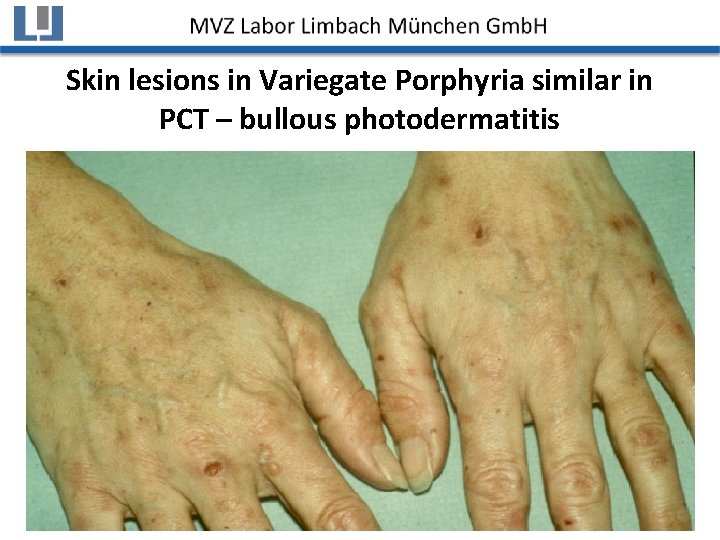 Skin lesions in Variegate Porphyria similar in PCT – bullous photodermatitis 