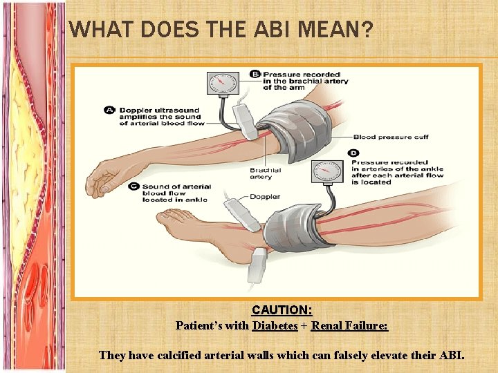 WHAT DOES THE ABI MEAN? ABI Clinical Correlation >0. 9 Normal Limb 0. 5