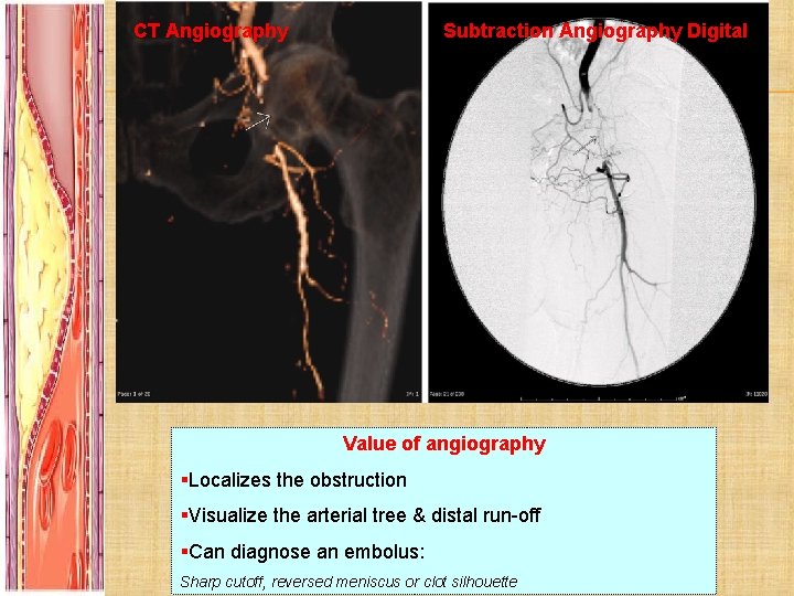 CT Angiography Subtraction Angiography Digital Value of angiography §Localizes the obstruction §Visualize the arterial