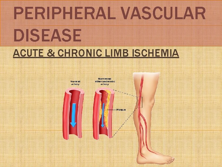 PERIPHERAL VASCULAR DISEASE ACUTE & CHRONIC LIMB ISCHEMIA 