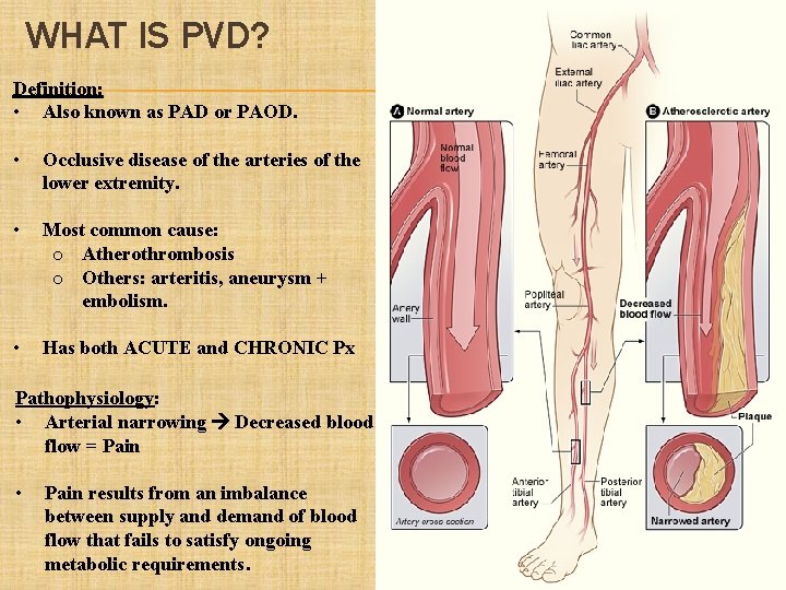 WHAT IS PVD? Definition: • Also known as PAD or PAOD. • Occlusive disease