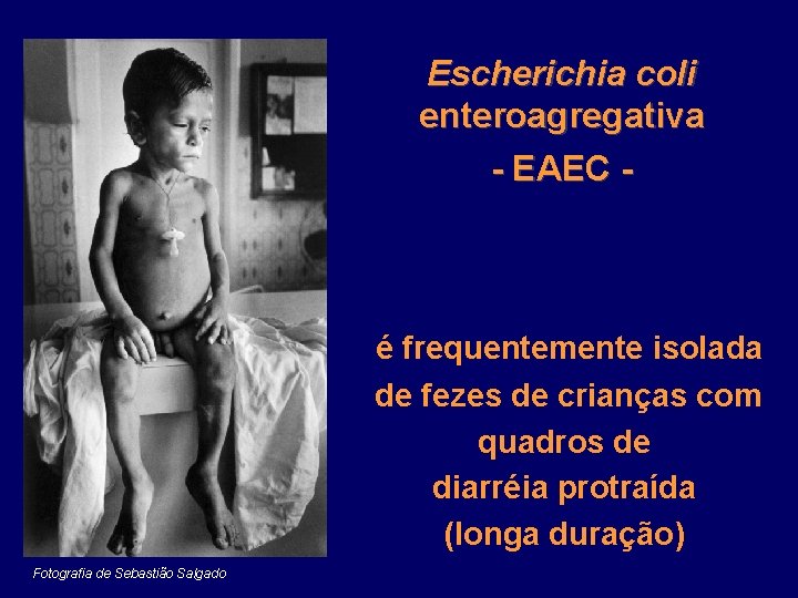 Escherichia coli enteroagregativa - EAEC - é frequentemente isolada de fezes de crianças com