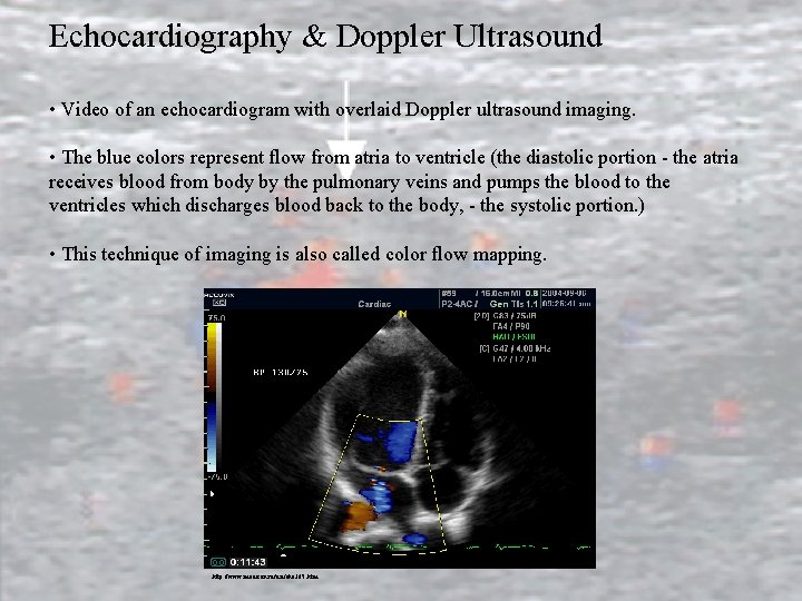 Echocardiography & Doppler Ultrasound • Video of an echocardiogram with overlaid Doppler ultrasound imaging.