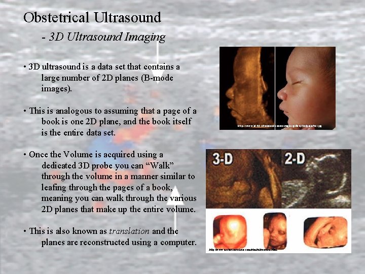 Obstetrical Ultrasound - 3 D Ultrasound Imaging • 3 D ultrasound is a data