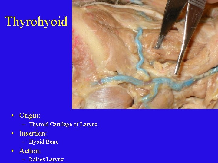 Thyrohyoid • Origin: – Thyroid Cartilage of Larynx • Insertion: – Hyoid Bone •