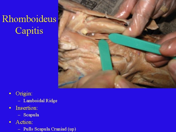 Rhomboideus Capitis • Origin: – Lamboidal Ridge • Insertion: – Scapula • Action: –